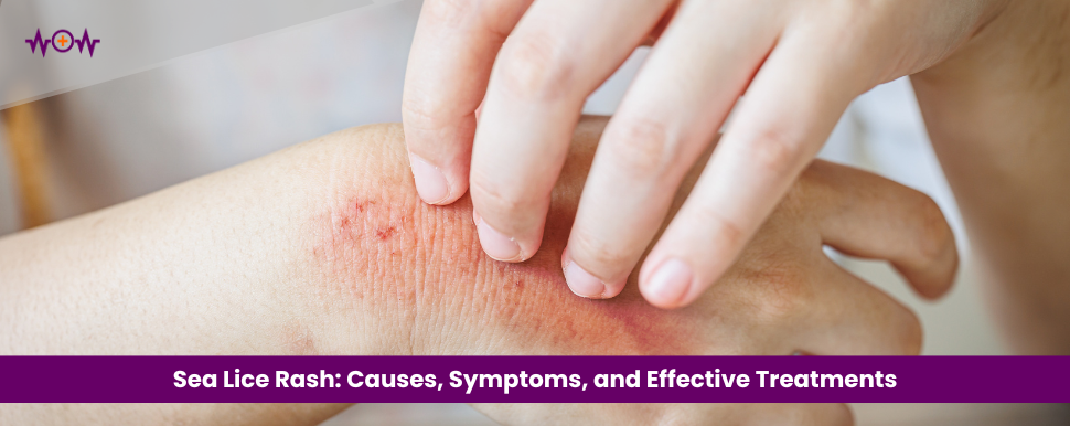 Sea Lice Rash: Causes, Symptoms, and Effective Treatments